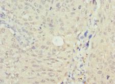 NSFL1C Antibody - Immunohistochemistry of paraffin-embedded human lung cancer at dilution 1:100