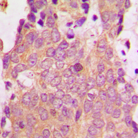 NSG1 Antibody - Immunohistochemical analysis of NSG1 staining in human breast cancer formalin fixed paraffin embedded tissue section. The section was pre-treated using heat mediated antigen retrieval with sodium citrate buffer (pH 6.0). The section was then incubated with the antibody at room temperature and detected using an HRP conjugated compact polymer system. DAB was used as the chromogen. The section was then counterstained with hematoxylin and mounted with DPX.