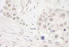 NSL1 Antibody - Detection of Human DC8 by Immunohistochemistry. Sample: FFPE section of human breast carcinoma. Antibody: Affinity purified rabbit anti-DC8 used at a dilution of 1:250. Epitope Retrieval Buffer-High pH (IHC-101J) was substituted for Epitope Retrieval Buffer-Reduced pH.