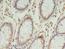 NSUN4 Antibody - Immunohistochemistry of paraffin-embedded human colon cancer using antibody at dilution of 1:100.