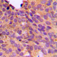 NT5C1B Antibody - Immunohistochemical analysis of NT5C1B staining in human breast cancer formalin fixed paraffin embedded tissue section. The section was pre-treated using heat mediated antigen retrieval with sodium citrate buffer (pH 6.0). The section was then incubated with the antibody at room temperature and detected using an HRP conjugated compact polymer system. DAB was used as the chromogen. The section was then counterstained with hematoxylin and mounted with DPX.