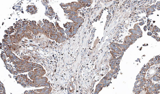 NT5C2 Antibody - IHC of paraffin-embedded OVCA using NT5C2 antibody at 1:100 dilution.