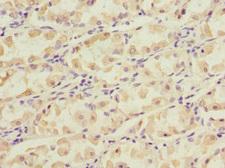 NT5C3A Antibody - Immunohistochemistry of paraffin-embedded human gastric cancer at dilution 1:100