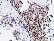 NT5DC1 Antibody - IHC of paraffin-embedded Adenocarcinoma of Human breast tissue using anti-NT5DC1 mouse monoclonal antibody.