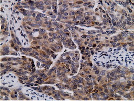 NT5DC1 Antibody - IHC of paraffin-embedded Adenocarcinoma of Human ovary tissue using anti-NT5DC1 mouse monoclonal antibody.