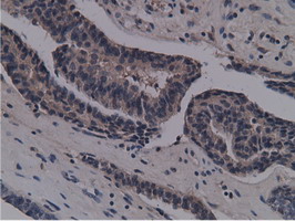 NT5DC1 Antibody - IHC of paraffin-embedded Adenocarcinoma of Human endometrium tissue using anti-NT5DC1 mouse monoclonal antibody.
