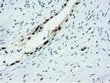 NT5DC1 Antibody - IHC of paraffin-embedded Carcinoma of Human pancreas tissue using anti-NT5DC1 mouse monoclonal antibody.