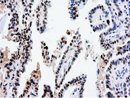 NT5DC1 Antibody - IHC of paraffin-embedded Carcinoma of Human thyroid tissue using anti-NT5DC1 mouse monoclonal antibody.