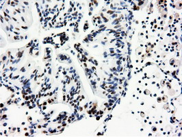 NT5DC1 Antibody - IHC of paraffin-embedded Carcinoma of Human lung tissue using anti-NT5DC1 mouse monoclonal antibody.