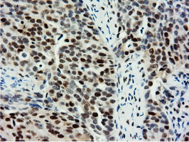 NT5DC1 Antibody - IHC of paraffin-embedded Adenocarcinoma of Human ovary tissue using anti-NT5DC1 mouse monoclonal antibody.