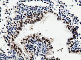 NT5DC1 Antibody - IHC of paraffin-embedded Carcinoma of Human prostate tissue using anti-NT5DC1 mouse monoclonal antibody.