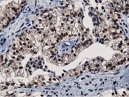 NT5DC1 Antibody - IHC of paraffin-embedded Adenocarcinoma of Human ovary tissue using anti-NT5DC1 mouse monoclonal antibody.