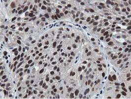 NT5DC1 Antibody - IHC of paraffin-embedded Carcinoma of Human bladder tissue using anti-NT5DC1 mouse monoclonal antibody.