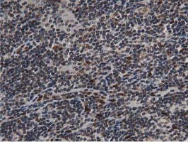 NT5DC1 Antibody - IHC of paraffin-embedded Human lymphoma tissue using anti-NT5DC1 mouse monoclonal antibody.