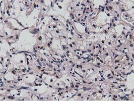 NT5DC1 Antibody - IHC of paraffin-embedded Carcinoma of Human kidney tissue using anti-NT5DC1 mouse monoclonal antibody.