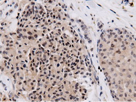 NT5DC1 Antibody - IHC of paraffin-embedded Adenocarcinoma of Human breast tissue using anti-NT5DC1 mouse monoclonal antibody.