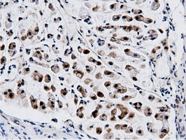 NT5DC1 Antibody - IHC of paraffin-embedded Adenocarcinoma of Human colon tissue using anti-NT5DC1 mouse monoclonal antibody.