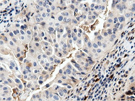 NT5DC1 Antibody - IHC of paraffin-embedded Carcinoma of Human bladder tissue using anti-NT5DC1 mouse monoclonal antibody.