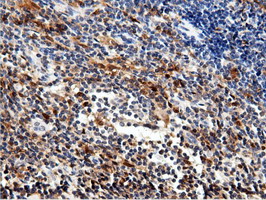 NT5DC1 Antibody - IHC of paraffin-embedded Human lymphoma tissue using anti-NT5DC1 mouse monoclonal antibody.
