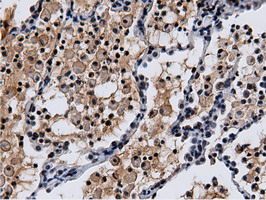 NT5DC1 Antibody - IHC of paraffin-embedded Carcinoma of Human lung tissue using anti-NT5DC1 mouse monoclonal antibody.