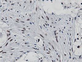 NT5DC1 Antibody - IHC of paraffin-embedded Carcinoma of Human pancreas tissue using anti-NT5DC1 mouse monoclonal antibody.