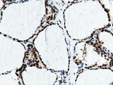 NT5DC1 Antibody - Immunohistochemical staining of paraffin-embedded Human thyroid tissue using anti-NT5DC1 mouse monoclonal antibody.