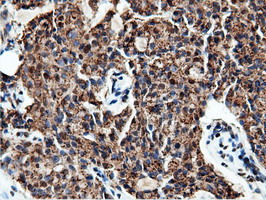 NT5DC1 Antibody - Immunohistochemical staining of paraffin-embedded Adenocarcinoma of Human breast tissue using anti-NT5DC1 mouse monoclonal antibody.