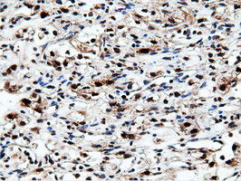 NT5DC1 Antibody - Immunohistochemical staining of paraffin-embedded Carcinoma of Human kidney tissue using anti-NT5DC1 mouse monoclonal antibody.