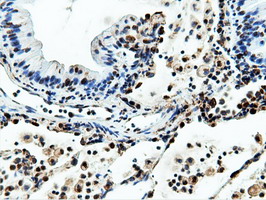 NT5DC1 Antibody - Immunohistochemical staining of paraffin-embedded Carcinoma of Human lung tissue using anti-NT5DC1 mouse monoclonal antibody.