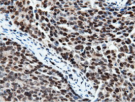 NT5DC1 Antibody - Immunohistochemical staining of paraffin-embedded Adenocarcinoma of Human ovary tissue using anti-NT5DC1 mouse monoclonal antibody.