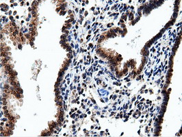 NT5DC1 Antibody - Immunohistochemical staining of paraffin-embedded Carcinoma of Human prostate tissue using anti-NT5DC1 mouse monoclonal antibody.