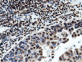NT5DC1 Antibody - Immunohistochemical staining of paraffin-embedded Carcinoma of Human bladder tissue using anti-NT5DC1 mouse monoclonal antibody.