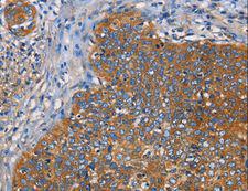 NT5E / eNT / CD73 Antibody - Immunohistochemistry of paraffin-embedded Human cervical cancer using NT5E Polyclonal Antibody at dilution of 1:40.