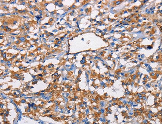 NT5E / eNT / CD73 Antibody - Immunohistochemistry of paraffin-embedded Human thyroid cancer using NT5E Polyclonal Antibody at dilution of 1:40.