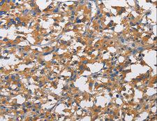 NT5E / eNT / CD73 Antibody - Immunohistochemistry of paraffin-embedded Human liver cancer using NT5E Polyclonal Antibody at dilution of 1:50.
