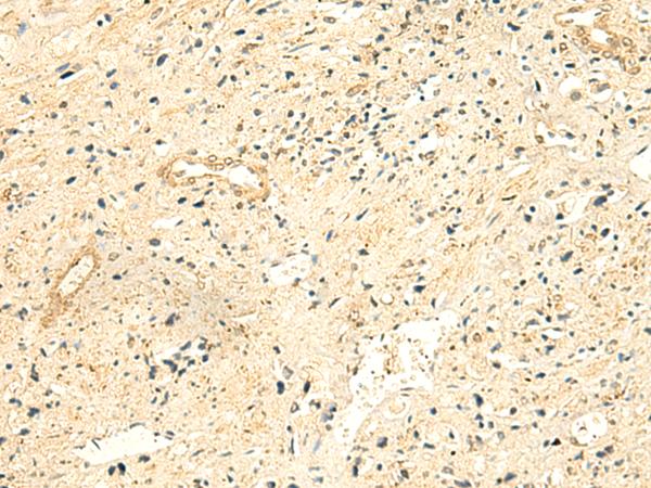 NTAN1 / PNAD Antibody - Immunohistochemistry of paraffin-embedded Human prost ate cancer tissue  using NTAN1 Polyclonal Antibody at dilution of 1:50(×200)