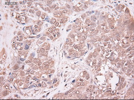 NTF3 / Neurotrophin 3 Antibody - IHC of paraffin-embedded Adenocarcinoma of breast using anti-NTF3 mouse monoclonal antibody.