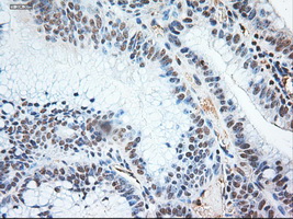 NTF3 / Neurotrophin 3 Antibody - IHC of paraffin-embedded Adenocarcinoma of colon using anti-NTF3 mouse monoclonal antibody.