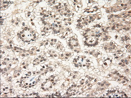 NTF3 / Neurotrophin 3 Antibody - IHC of paraffin-embedded Carcinoma of kidney using anti-NTF3 mouse monoclonal antibody.