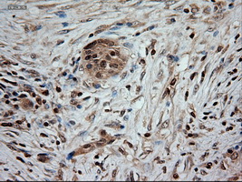 NTF3 / Neurotrophin 3 Antibody - IHC of paraffin-embedded Carcinoma of pancreas using anti-NTF3 mouse monoclonal antibody.