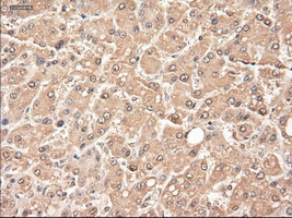 NTF3 / Neurotrophin 3 Antibody - IHC of paraffin-embedded Carcinoma of liver using anti-NTF3 mouse monoclonal antibody.