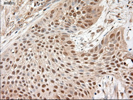 NTF3 / Neurotrophin 3 Antibody - IHC of paraffin-embedded Carcinoma of lung using anti-NTF3 mouse monoclonal antibody.