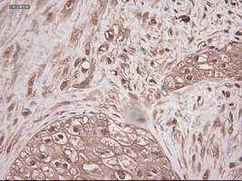 NTF3 / Neurotrophin 3 Antibody - IHC of paraffin-embedded Carcinoma of pancreas using anti-NTF3 mouse monoclonal antibody.