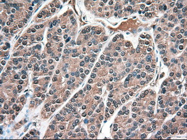 NTF3 / Neurotrophin 3 Antibody - IHC of paraffin-embedded Carcinoma of thyroid using anti-NTF3 mouse monoclonal antibody.