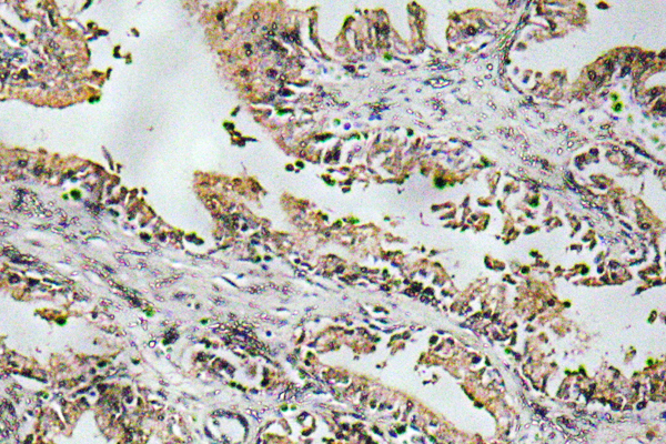 NTF4 / Neurotrophin 4 Antibody - Immunohistochemistry analysis of NT-4 antibody in paraffin-embedded human prostate carcinoma tissue.