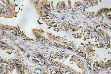 NTF4 / Neurotrophin 4 Antibody - Immunohistochemistry analysis of NT-4 antibody in paraffin-embedded human prostate carcinoma tissue.