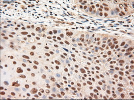 NTF4 / Neurotrophin 4 Antibody - Immunohistochemical staining of paraffin-embedded Carcinoma of lung using anti-NTF4 mouse monoclonal antibody.