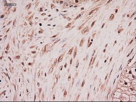 NTF4 / Neurotrophin 4 Antibody - Immunohistochemical staining of paraffin-embedded Carcinoma of pancreas using anti-NTF4 mouse monoclonal antibody.