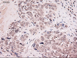 NTF4 / Neurotrophin 4 Antibody - Immunohistochemical staining of paraffin-embedded Adenocarcinoma of breast using anti-NTF4 mouse monoclonal antibody.
