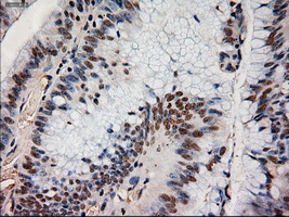 NTF4 / Neurotrophin 4 Antibody - Immunohistochemical staining of paraffin-embedded Adenocarcinoma of colon using anti-NTF4 mouse monoclonal antibody.